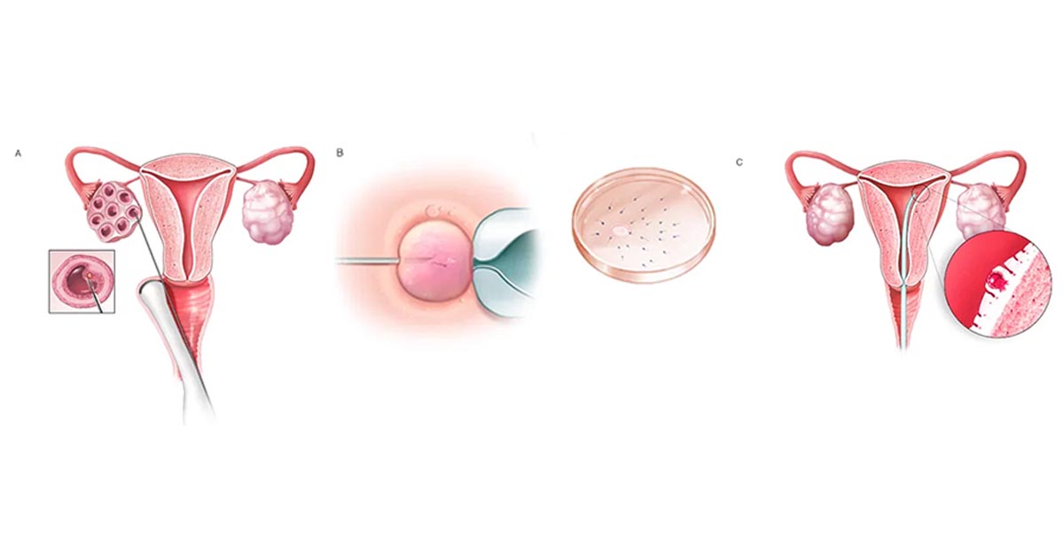 Metodo-FIV-como-funciona-etapas-passo-a-passo-e-taxas-de-sucesso