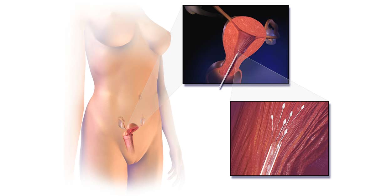 Inseminação Artificial: para quem é indicado e como se preparar? 2 Para-Quem-e-Indicado-e-Como-se-Prepara